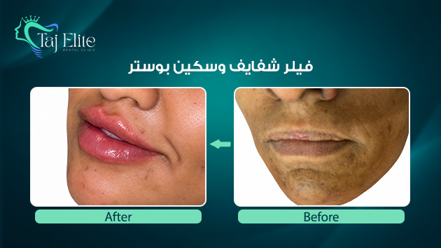 before-^-after